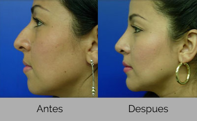rinoplastia