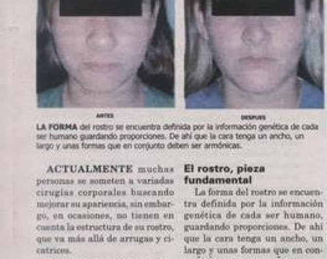 bichectomia